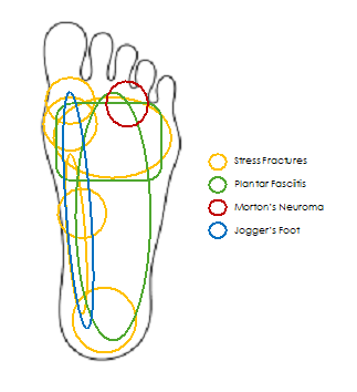 Some of the common types of foot pain from running & where they may be felt